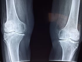Unlocking The Secrets Of Bone Health: Crucial Role Of Iron And Vitamins Unlocking The Secrets Of Bone Health: Crucial Role Of Iron And Vitamins