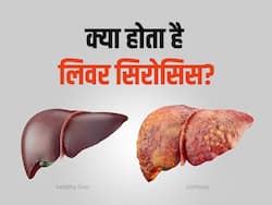 लिवर सिरोसिस हो सकता है जानलेवा, जानिए क्या हैं इसके लक्षण और रोकथाम के उपाय