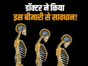 World osteoporosis day: हड्डियां पड़ रही कमजोर तो सावधान! डॉक्टर ने बताया इस बीमारी को इग्नोर किया तो बढ़ सकता है बोन फ्रैक्चर का खतरा