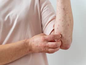 Be Aware Of These Highly Contagious Skin Infections