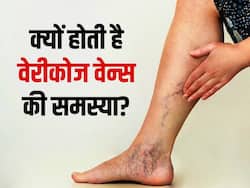 लंबे समय तक खड़े रहने वालों को होती है ये बीमारी, पैरों की नसें बन जाती हैं काली और मोटी, जानें इस गम्भीर बीमारी के लक्षण-कारण