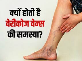 लंबे समय तक खड़े रहने वालों को होती है ये बीमारी, पैरों की नसें बन जाती हैं काली और मोटी, जानें इस गम्भीर बीमारी के लक्षण-कारण