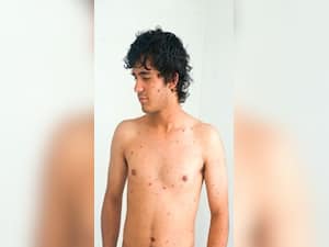 10 Signs and Symptoms of Measles