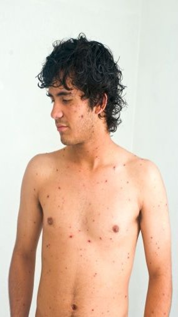 10 Signs and Symptoms of Measles