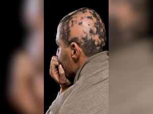 Alopecia Areata: Symptoms You Should Know