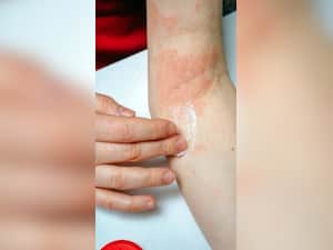 Atopic Dermatitis: Early Symptoms to be Aware of