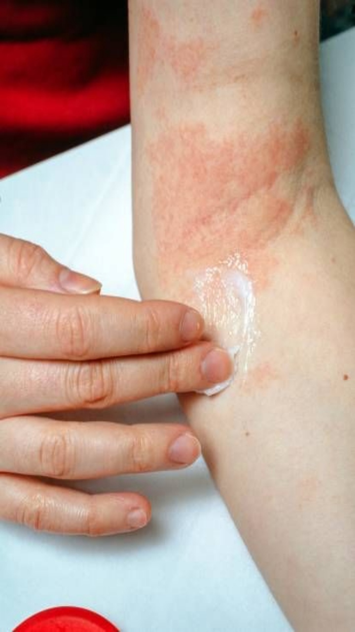 Atopic Dermatitis: Early Symptoms to be Aware of