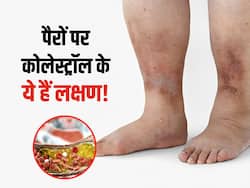 पैरों की स्किन के रंग में बदलाव हो सकते हैं हाई कोलेस्ट्रॉल के संकेत, जानिए इसके अन्य 5 लक्षण