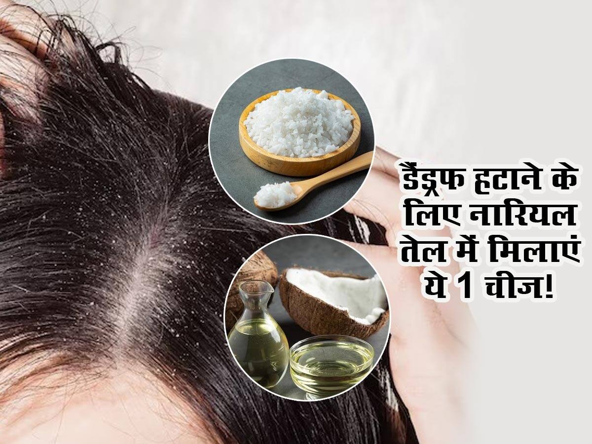 How To Use Coconut Oil And Camphor For Dandruff नारियल तेल में इस एक