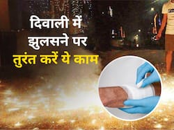 दिवाली पर स्किन झुलसने पर तुरंत करें ये 5 काम, बिना मरहम के भी दर्द से मिलेगा आराम