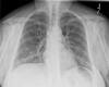 What Is Multifocal Pneumonia? Causes, Symptoms And Treatment