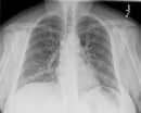 What Is Multifocal Pneumonia? Causes, Symptoms And Treatment