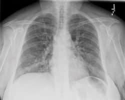 What Is Multifocal Pneumonia? Causes, Symptoms And Treatment