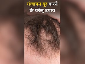 गंजेपन से छुटकारा दिलाएंगे ये 8 घरेलू उपाय