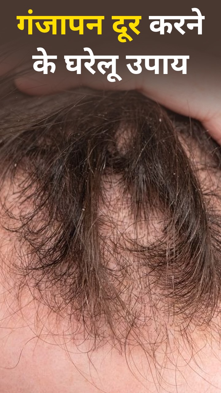 गंजेपन से छुटकारा दिलाएंगे ये 8 घरेलू उपाय