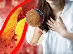 How To Lower Cholesterol With Ayurveda: 10 Herbs To Naturally Lower LDL Bad Cholesterol Without Medication