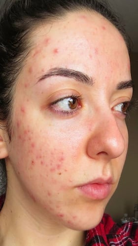 Easy And Effective Tips To Get Rid of Skin Boils