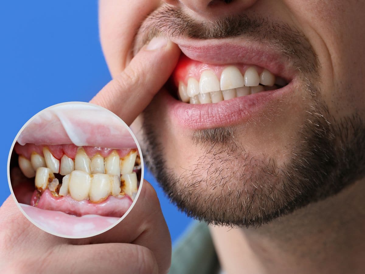 5 Effective Home Remedies to Prevent Oral Cavities at Home Without  Medication | TheHealthSite.com