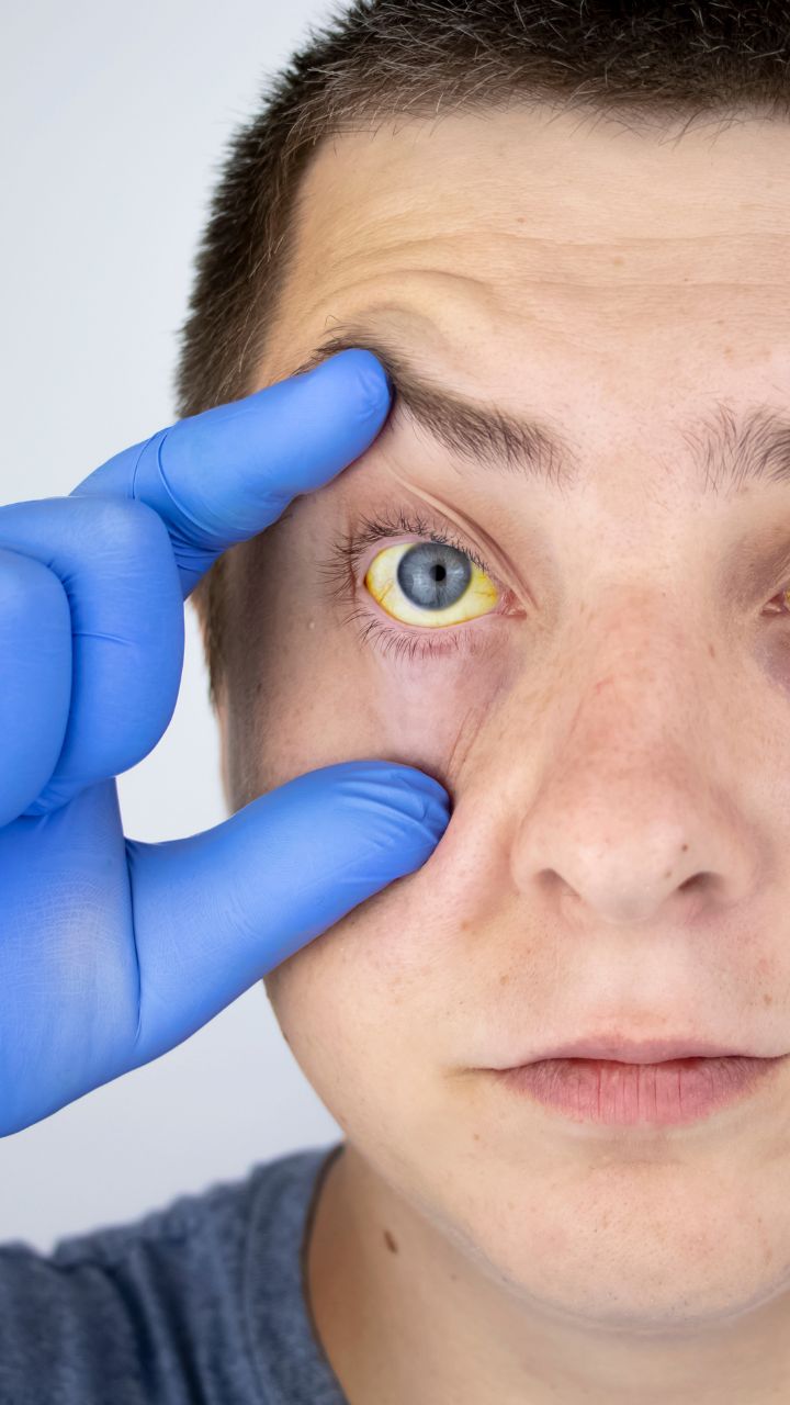 Vitamin B12 Deficiency Symptoms In Eyes That Can Often Go Undetected