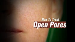 Skin Care Tips: 2 Amazing Home Remedies for Open Pores You Must Try