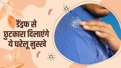 Home Remedies for Dandruff: बालोें में डैंड्रफ से हैं परेशान, तो ये 3 घरेलू नुस्खे करेंगे आपकी मदद