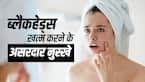 ​Home Remedies to Remove Blackheads: इन नुस्खे से सिर्फ 5 मिनट में दूर होंगे ब्लैकहेड्स