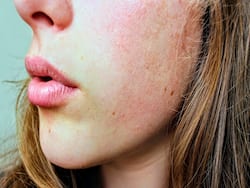 5 Uncommon Reasons Why You May Have Dry Patches On Your Skin