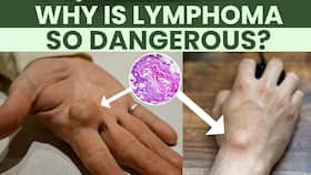 Lymphoma: Causes, symptoms, and pediatric care !