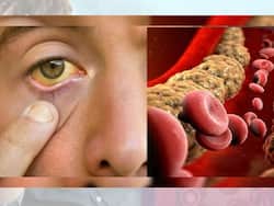 High Cholesterol: 5 Ayurvedic Tips to Lower LDL Levels Naturally Without Medication