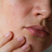 7 Common Skin And Lip Issues During Monsoon