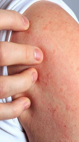 9 Ways To Alleviate Cold Rashes Naturally