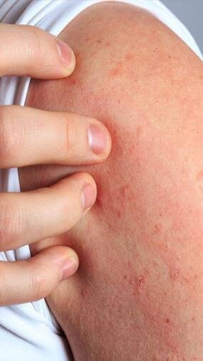 9 Ways To Alleviate Cold Rashes Naturally