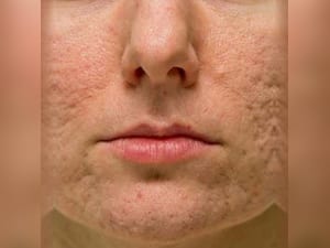 Top 9 Home Remedies to Cure Sunburn Lips