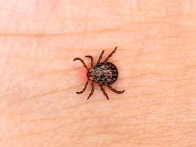 What Is Rocky Mountain Spotted Fever?