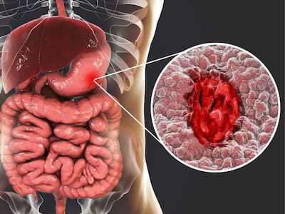Blood In Stool And 5 Other Warning Signs of Gastric Cancer You Should