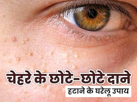 चेहरे पर हो गए हैं छोटे-छोटे दाने? छुटकारा पाने के लिए आजमाएं ये घरेलू उपाय, साफ हो जाएगी स्किन