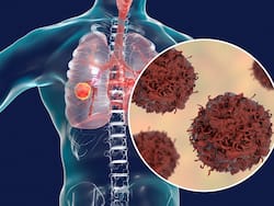 рдкреНрд░рджреВрд╖рдг рд╕реЗ рд▓рдВрдЧреНрд╕ рдбрд┐рдЬреАрдЬ рд╣реА рдирд╣реАрдВ рд╕реНрдЯреНрд░реЛрдХ рдХрд╛ рднреА рд╣реИ рдЦрддрд░рд╛,┬ардбреЙрдХреНрдЯрд░ рд╕реЗ рдЬрд╛рдирд┐рдП рдХрд┐рди-рдХрд┐рди рдмреАрдорд╛рд░рд┐рдпрд╛рдВ рдХрд╛ рд░рд╣рддрд╛ рд╣реИ рдЦрддрд░рд╛