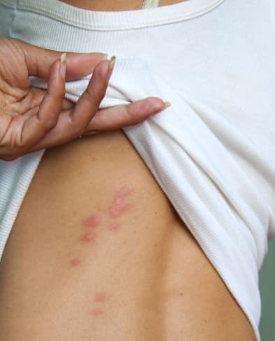Effective Tips to Get Quick Relief from Spider Bites - Vimarsana News