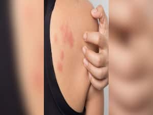 7 Effective Remedies to Manage Stress Rashes at Home