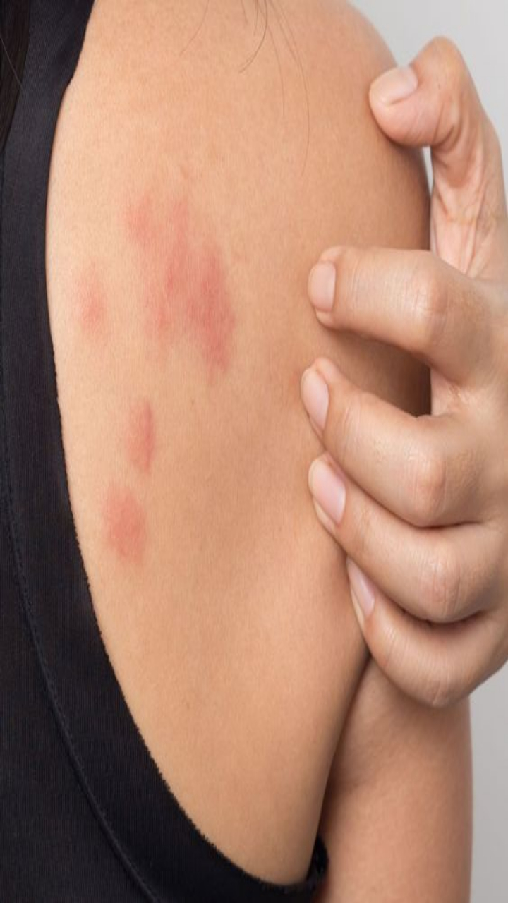 7 Effective Remedies to Manage Stress Rashes at Home