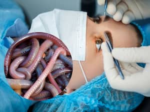 China Doctors Remove 60 Live Worms From Woman's Eyes: Rare