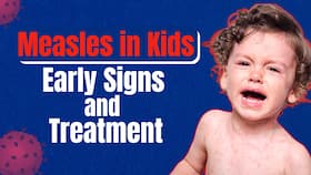 Measles: Symptoms, Treatment, and Vaccination Know all about it ! Measles: Symptoms, Treatment, and Vaccination Know all about it !