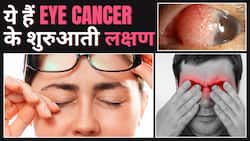 World Cancer Day 2024: इन लक्षणों को ना करें Ignore! हो सकते है Eye Cancer