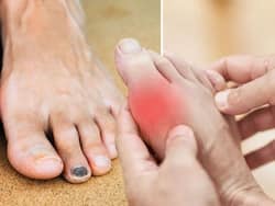 5 High Cholesterol Symptoms That May Appear On Your Feet And Legs At Night
