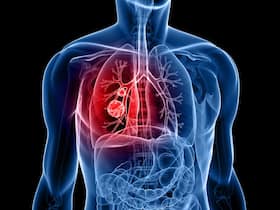 FRIDAY Lung Cancer Treatment: Traditional Approach Vs Multidisciplinary Care