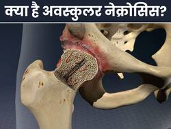 अवस्कुलर नेक्रोसिस (AVN) में ढहने लगती हैं हड्डियां, जानिए इसके लक्षण और कारण