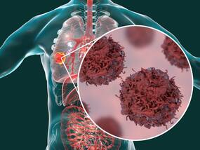 Cancer Causing Diet: 6 Foods And Drinks That You Must Avoid To Lower Your Risk of Cancer