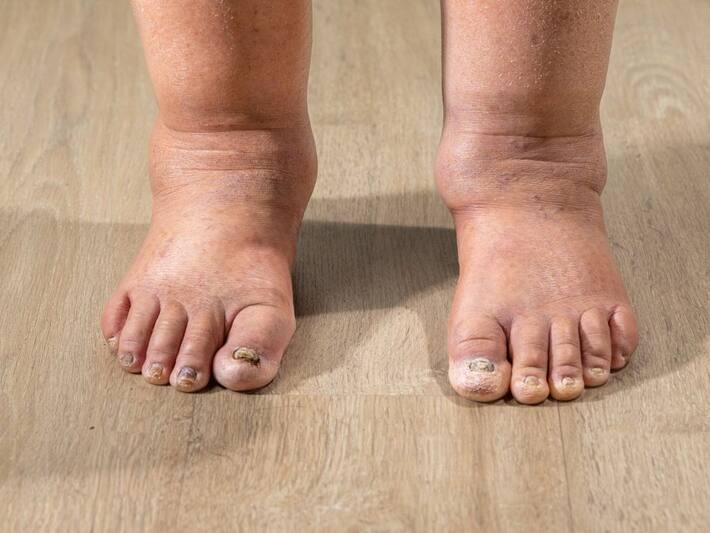5 High Cholesterol Symptoms That May Appear On Your Feet And Legs At