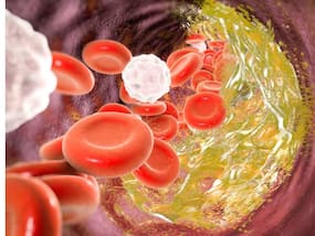 Lower High Blood Cholesterol Levels: 7 Ayurvedic Tips To Flush Out Bad LDL Cholesterol Naturally