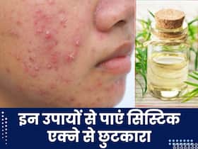 किन कारणों से चेहरे पर होते हैं सिस्टिक एक्ने? जानें इनसे छुटकारा पाने के उपाय